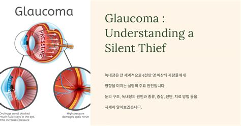 Glaucoma Understanding A Silent Thief
