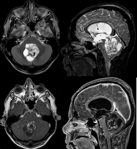 Subependymoma Axial T2 Weighted And T1 Weighted Axial And Sagittal