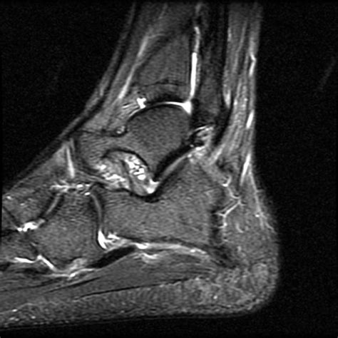 1 department of radiology and inje university busan paik hospital, inje university college of haglund syndrome was first described in 1928 as retrocalcaneal bursitis associated with an. Haglund syndrome | Radiology Case | Radiopaedia.org
