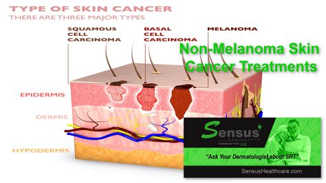 The Many Treatment Options For Non Melanoma Skin Cancer Sensus