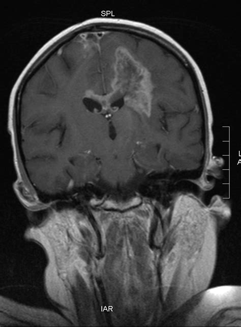 The earliest symptoms of breast cancer are easier to feel than see. A Brain Tumor: July 2015