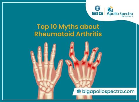 Causes Symptoms Treatment And Top 10 Myths About Rheumatoid Arthritis