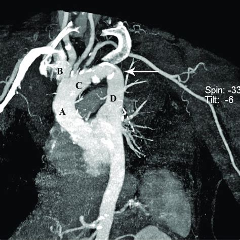 Aortic Arch Angiogram With Right Anterior Oblique Position Shows An