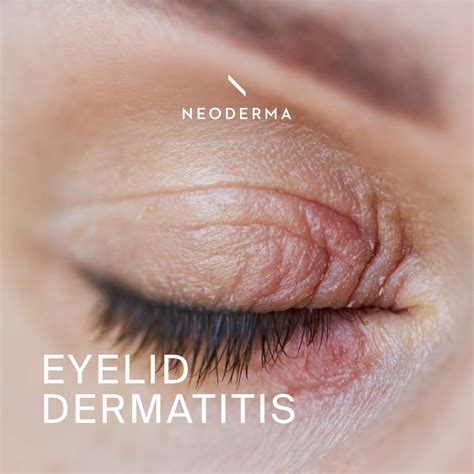 Eyelid Dermatitis Neoderma