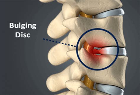 While disc bulges can eventually become disc herniations, a fully herniated cervical disc is much more severe than a bulge. Bulging Disc | Causes, Symptoms & Treatment | Bonati Spine ...