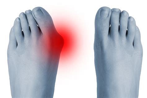 Die operation erfolgt unter vollnarkose oder unter einer. Operation Hallux Valgus - Orthinform