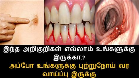 புற்றுநோயின் ஆரம்ப அறிகுறிகள் Cancer Symptoms In Tamil Nalam