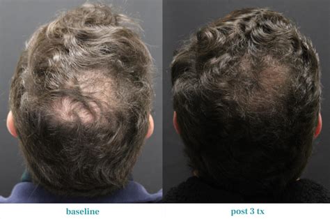 Alma Ted Revolutionizing Hair Loss Treatment With Ultrasound Technology