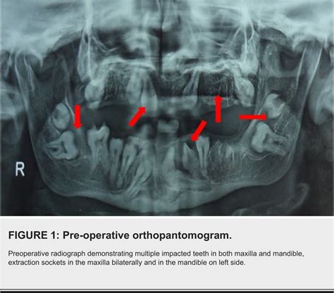 Figure 1 From Management Of Non Syndromic Multiple Impacted Teeth With