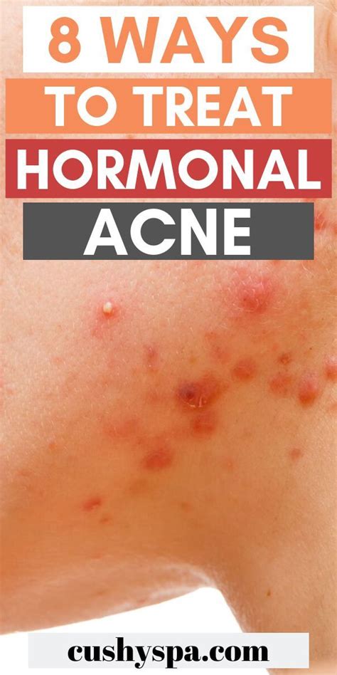 Hormonal Acne Can Be So Frustrating To Deal With Try These Natural