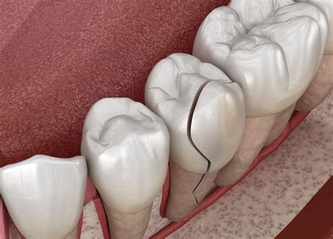 Available Treatments For A Broken Tooth Beavers Dentistry