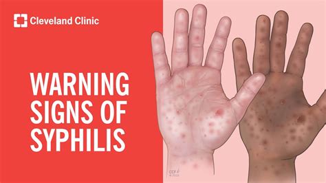 Warning Signs Of Syphilis Youtube