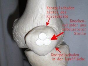 Kreuzbandriss (riss des vorderen kreuzbands). 43 HQ Images Kreuzbandriss Wann Operieren : Zwinger vom ...