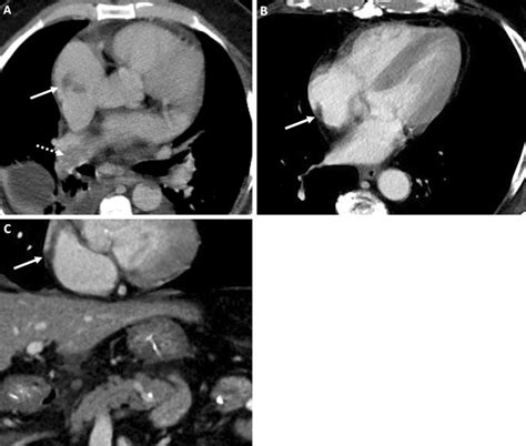 Right Atrial Thrombus And Pitfall A Contrast Enhanced Axial Ct