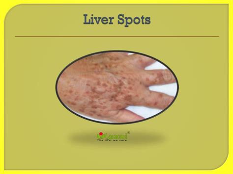 Ppt Liver Spots Causes Symptoms Daignosis Prevention And
