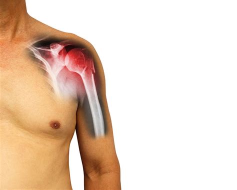 Clínica Traumacor | Traumatólogos Coruña | Rotura de troquiter derecho