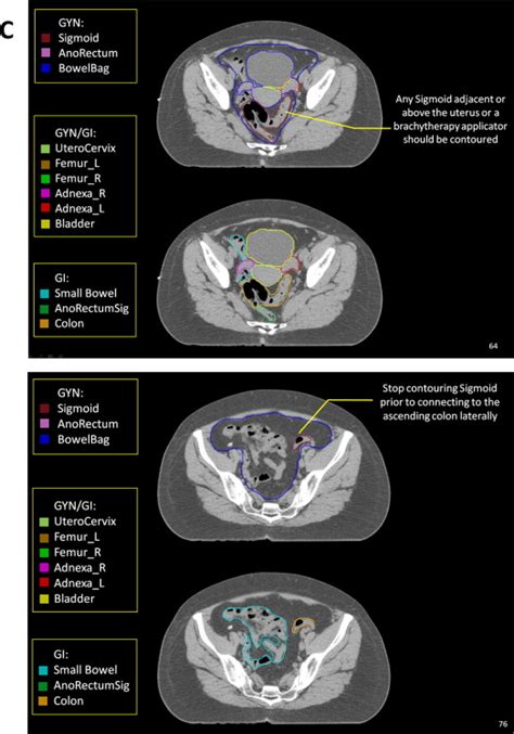 Pelvic Normal Tissue Contouring Guidelines For Radiation Therapy A Radiation Therapy Oncology