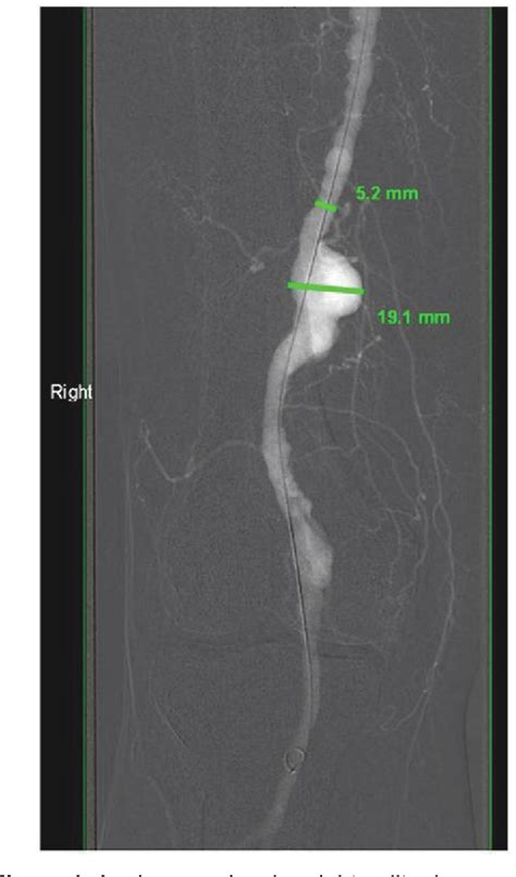 Figure 1 From Evaluation Diagnosis And Management Of Popliteal Artery