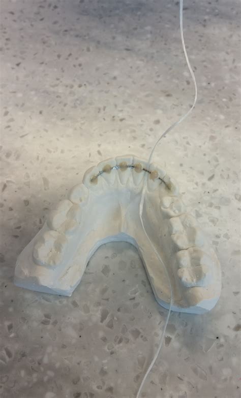 How to floss a permanent retainer | premier orthodontics. Flossing a Permanent Retainer