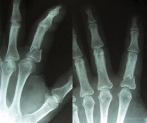 Phalanx Fractures Hand Orthobullets