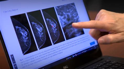 Ai Supported Mammogram Screening Increases Breast Cancer Detection By