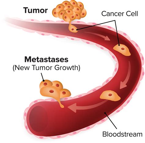 Metastasis Cancer Cell Metastasis Clipart Large Size Png Image Pikpng