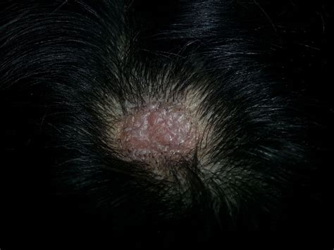 Help Scalp Sore Lump That Itches Scared At Ask Curezone Community