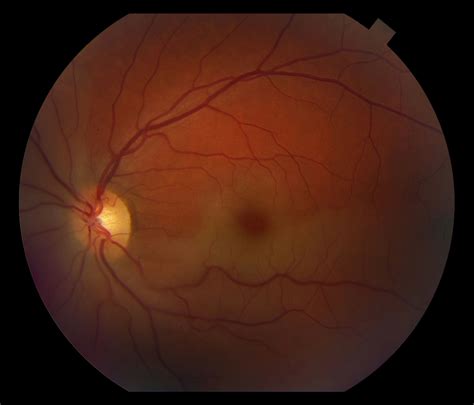 Moran Core Branched Retinal Artery Occlusion After