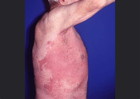 Update On Efficacy Of Treatments For Cutaneous Candidiasis