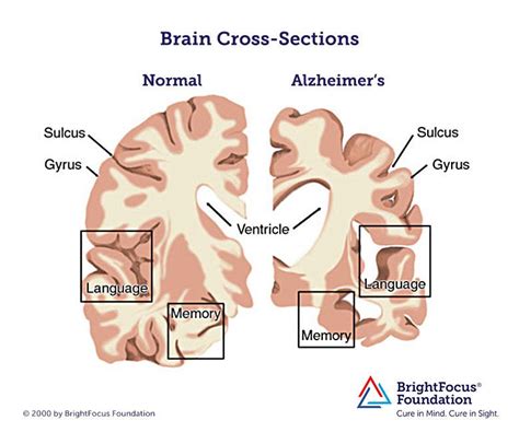 What Does An Alzheimers Brain Look Like Brightfocus Foundation