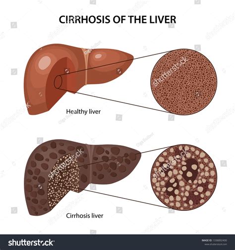 Cirrhosis Liver Histology Healthy Cirrhotic Liver เวกเตอร์สต็อก ปลอด