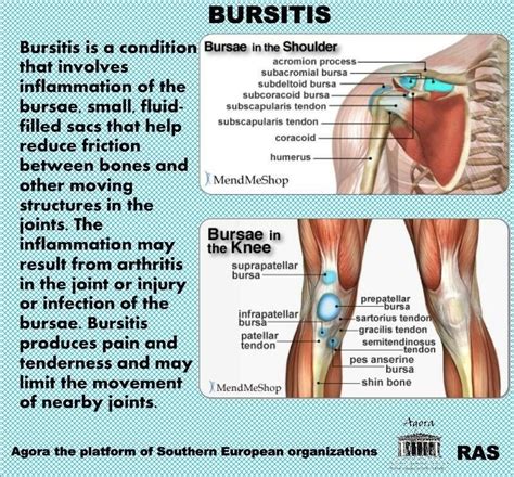 Bursitis Bursitis Bursitis Symptoms Bursitis Hip