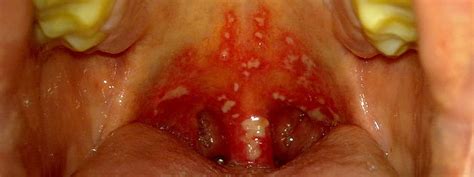 Lesen sie mehr über ihre symptome, behandlung und vorbeugung! Mundfäule (Gingivostomatitis ) durch Herpes Viren