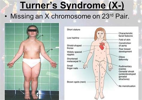 turner syndrome medizzy