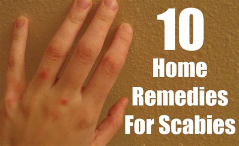 Webmd medical news, pets may prevent allergies in kids. uptodate.com. 10 Must Follow Home Remedies For Scabies | Find Home ...