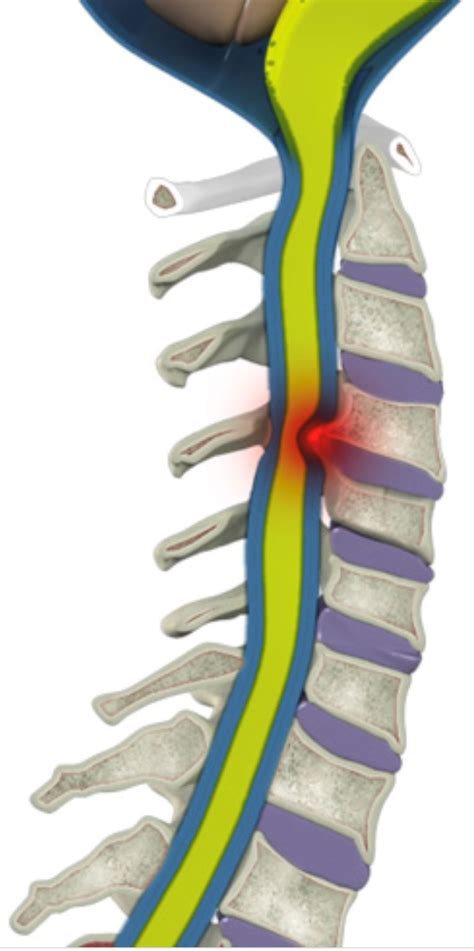 Asymptomatic Cervical Stenosis Legacy Spine And Neurological Specialists
