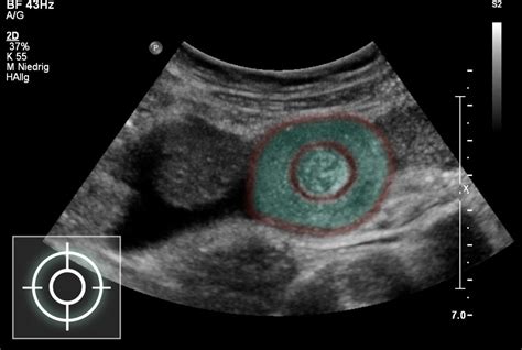 Intussusception Ultrasound