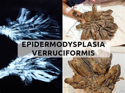 Epidermodysplasia Verruciformis