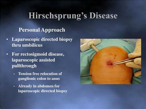 ppt hirschsprung s disease options for surgical correction powerpoint presentation id 5026679