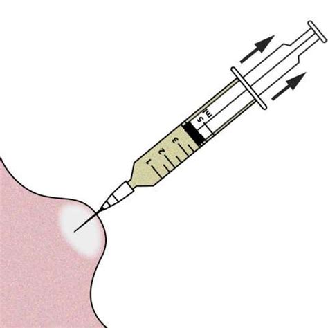 Fine Needle Aspirate Biopsy Fnab Cytopath
