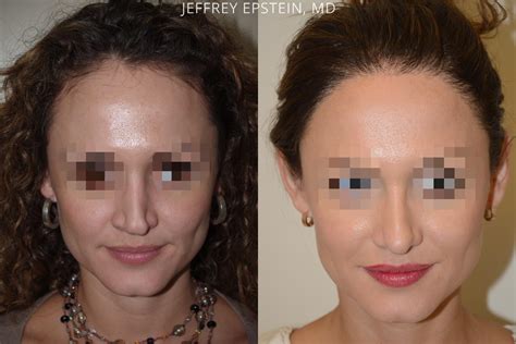 Ziering medical's male hair transplant before & after results. Hair Transplants for Women pictures | Miami, FL | Paciente ...