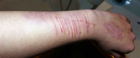 La mayoría de las personas que se cortan no intenta suicidarse. El cutting: la peligrosa práctica de cortarse la piel ...