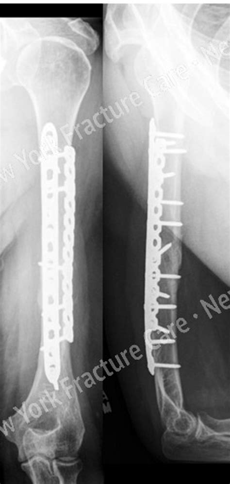 Nonunion Unhealed Fracture With Deformity Treatment New York