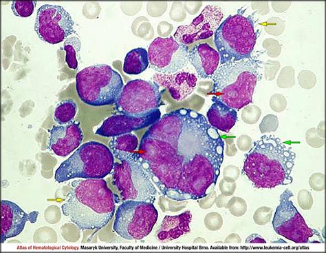 Peripheral T Cell Lymphoma Not Otherwise Specified Cell Atlas Of