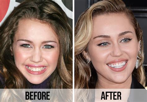 21 Celebrity Dental Implants And Veneers Before And After
