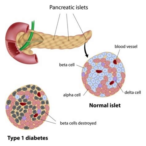 Pancreatic Islets Diabetes Treatment 2 Diabetes Life