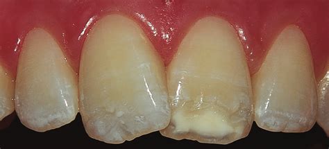 Tooth 9 With An Ivory White Hypomineralized Lesion In The Incisal