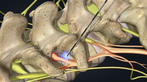 Lumbar Transforaminal Epidural Steroid Injection