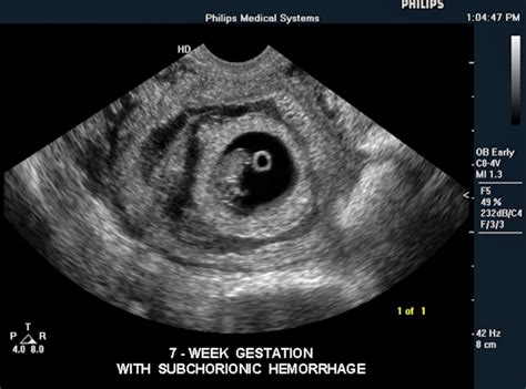 Fetal Ultrasound With Subchorionic Hemorrhage At Seven Weeks Imaged