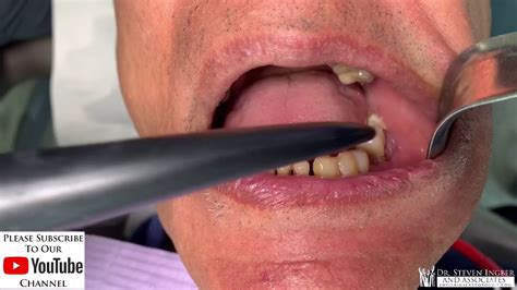 It should be treated with good hygiene, painkillers, clove oil, salt water and other simple home remedies. Gum abscess-9-1-1 - YouTube